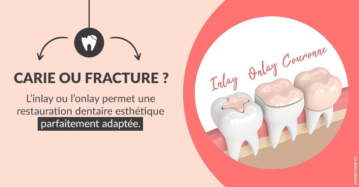 https://dr-jumeau-gersohn-corinne.chirurgiens-dentistes.fr/T2 2023 - Carie ou fracture 2
