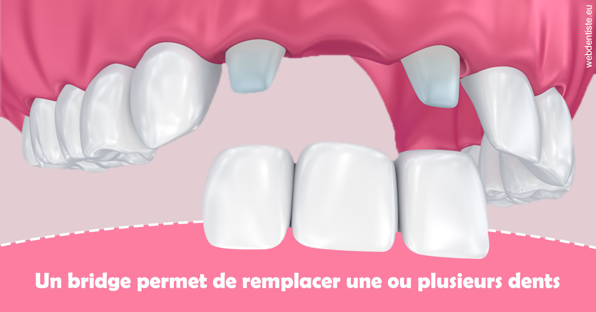 https://dr-jumeau-gersohn-corinne.chirurgiens-dentistes.fr/Bridge remplacer dents 2