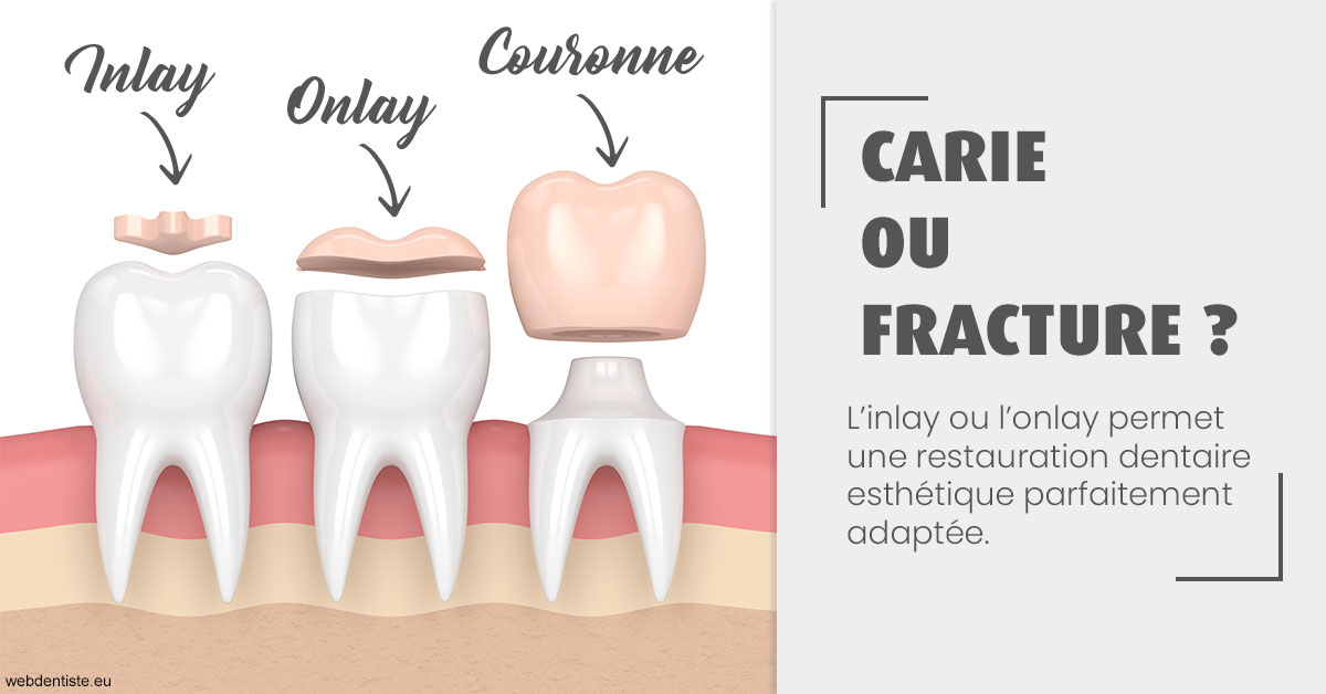 https://dr-jumeau-gersohn-corinne.chirurgiens-dentistes.fr/T2 2023 - Carie ou fracture 1